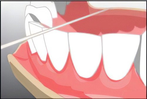 Conseils aux patients chirurgien dentiste Langon fil dentaire 1