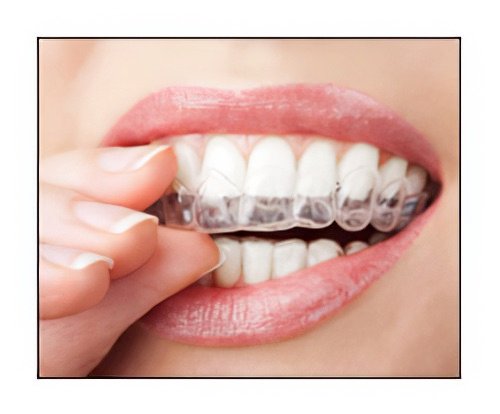 Conseils aux patients chirurgien dentiste Langon gouttière