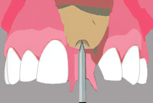 Implantologie dentaire Langon