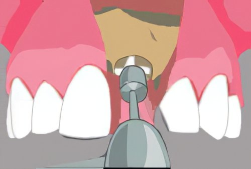 Implantologie dentaire Langon 5