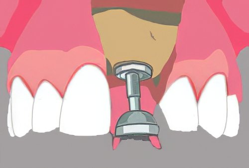 Implants dentaires Langon