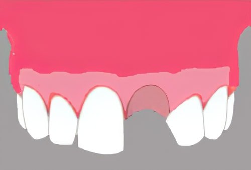 Implants dentaires Langon