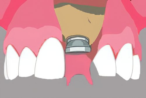 Implants dentaires Bazas_10