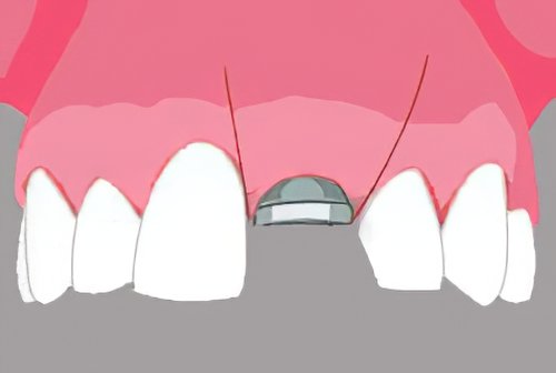 implantologie dentaire Landes