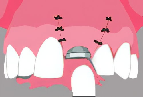 Implants dentaires Bazas_13