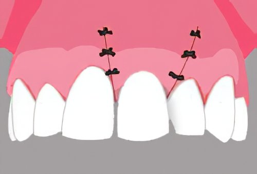 Implants dentaires Langon 14