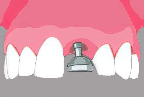 Implants dentaires Langon