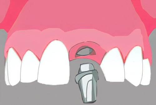 Implantologie dentaire Langon_17