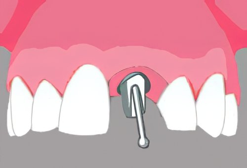 Implants dentaires Langon