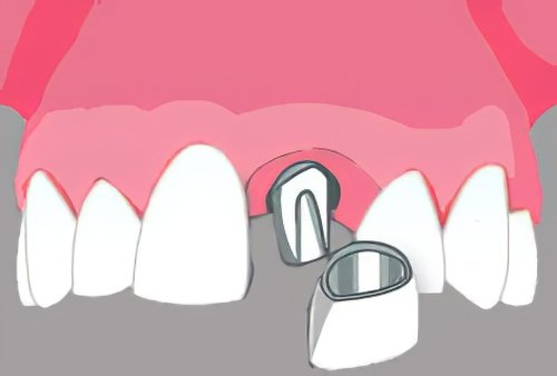 Implants dentaires Bazas_19