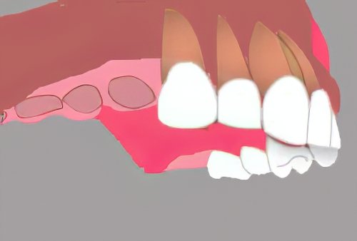 Implants dentaires Bazas_21