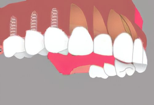 Implants dentaires Langon