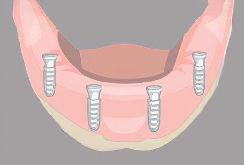 Implants dentaires Landes_27