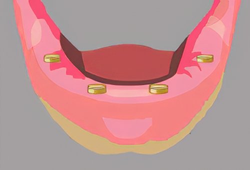 Implants dentaires Langon_29