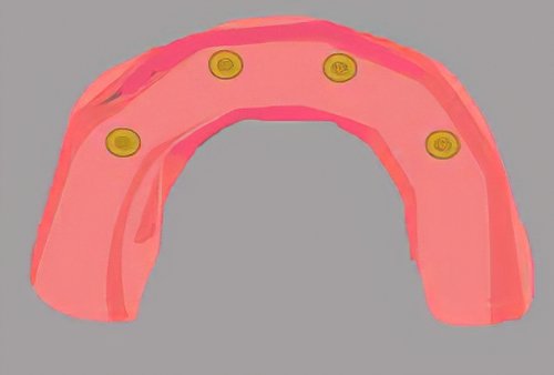 Implants dentaires Bazas_30