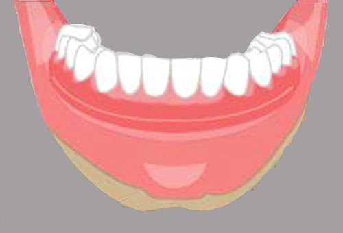 Implants dentaires Langon_33