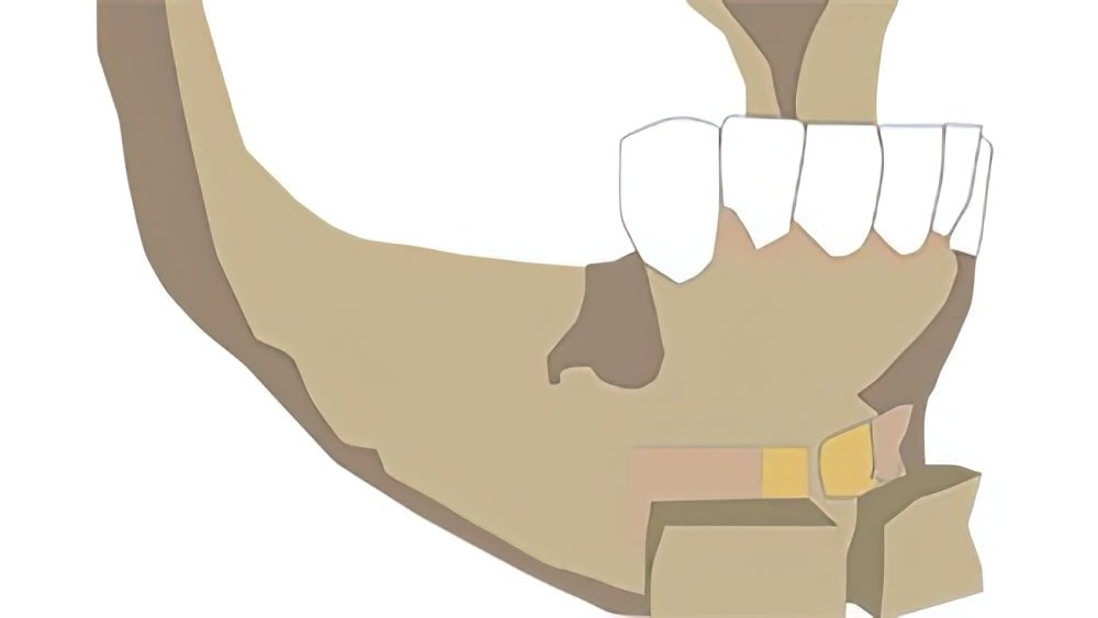greffes osseuses dentaires Langon apposition 2