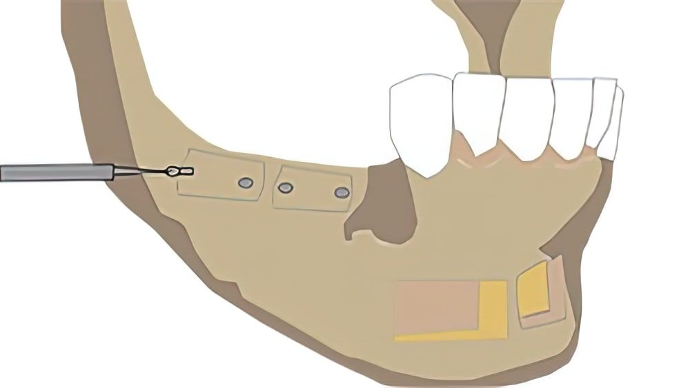 greffes osseuses dentaires Langon apposition 3