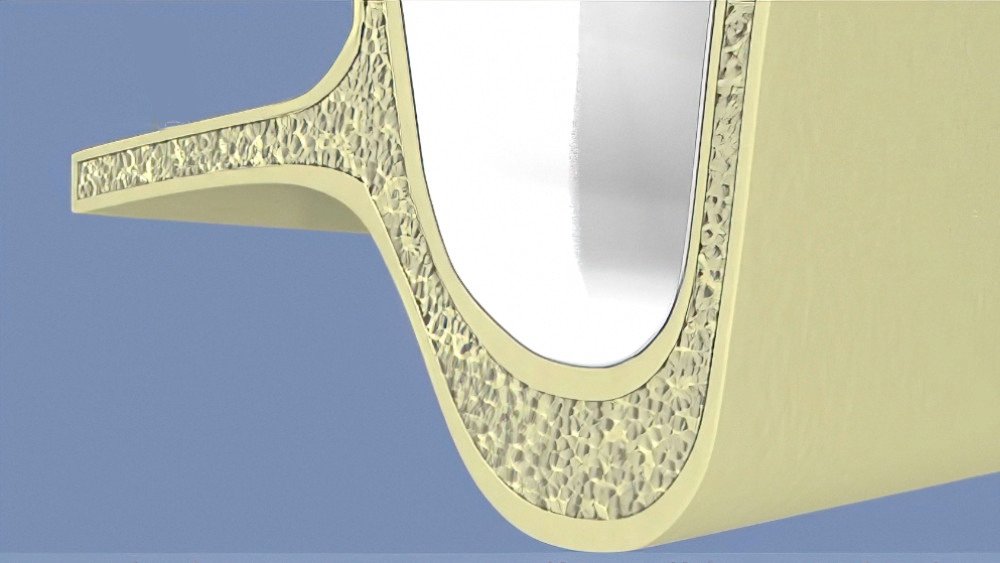 Greffe osseuse sinus langon 02