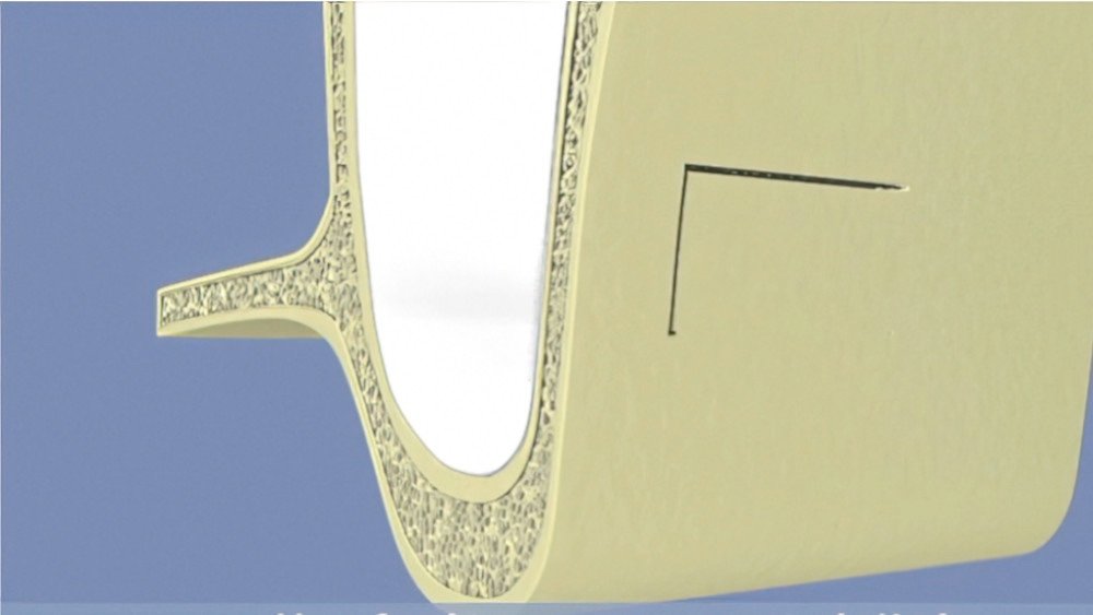 greffes osseuses dentaires Langon sinus 03