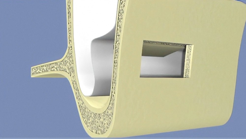 greffes osseuses dentaires Langon sinus 4