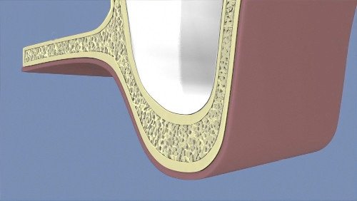 greffes osseuses dentaires Langon sinus 01