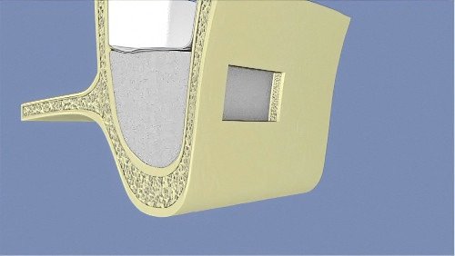 Greffe osseuse sinus langon 5