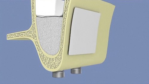 greffes osseuses dentaires Langon sinus 6