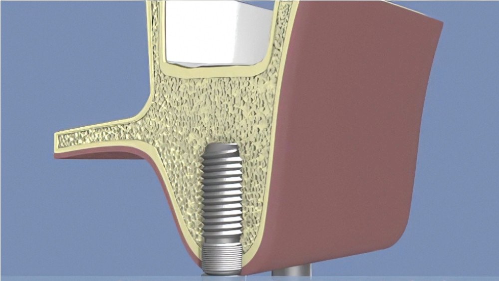 Greffe osseuse sinus langon 7